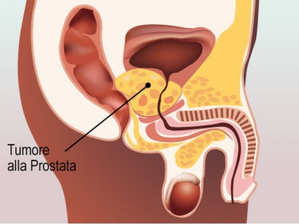 carcinoma-prostata - Liveuniversity