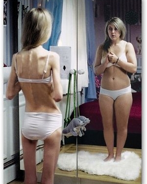 anoressia