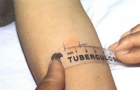 tubercolosi