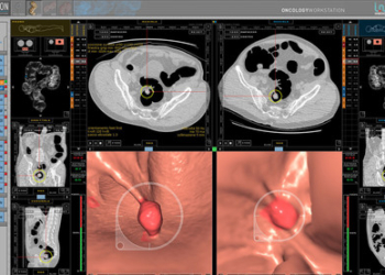 20080729 - TORINO - CRO : TUMORI: NUOVA COLONSCOPIA VIRTUALE SALVERA' PIU' VITE. IN PIEMONTE 6 ANNI RICERCA, 5 MILIONI PER TESTARLA CON SCREENING. Un'immagine dell'interfaccia Cad (Computer Aded Detection)-colon.  Per combattere il tumore del colon retto, seconda causa di morte per neoplasia in Occidente che in Italia colpisce ogni anno 20 mila persone uccidendone il 50%, e' stato messo a punto in Piemonte un nuovo esame diagnostico, la colonscopia virtuale. Realizzarla ha richiesto sei anni di ricerca, e gli studi preliminari compiuti dall'Ircc di Candiolo su una popolazione a elevato rischio hanno dimostrato la sua grande precisione. Il nuovo strumento diagnostico e' denominato Cad (Computer Aded Detection). La tecnica studia il colon retto utilizzando i dati di una tac, che viene effettuata dopo avere introdotto aria nell'intestino tramite una piccola sonda rettale.  TONINO DI MARCO / ANSA / PAL