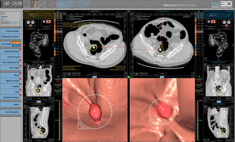 tumori nuova colonscopia virtuale salvera piu vite in piemonte 6 anni ricerca 5 milioni per testarla con screening