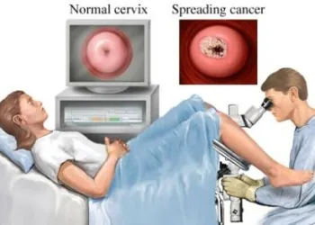 Wpid Cancro Cervicale1