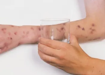 Meningite Mascali Catania